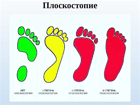 Индивидуальные случаи рассмотрения при наличии плоскостопия