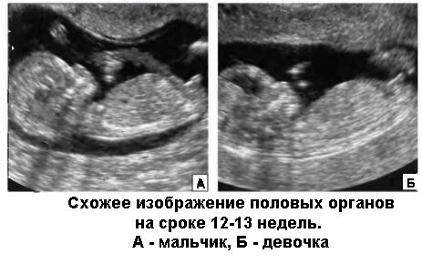 История возникновения метода определения пола плода по УЗИ