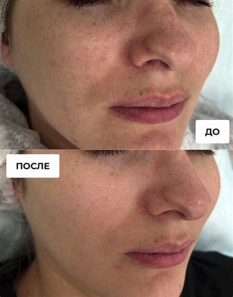 Как употреблять алкоголь при розацеа: советы и рекомендации