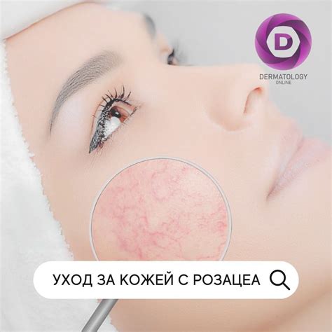 Рекомендуемый алкоголь для пациентов с розацеа