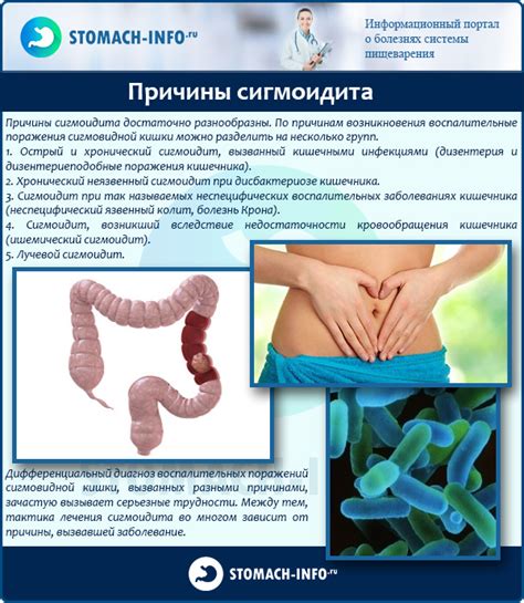 Сигмоидит: виды, причины, диагностика