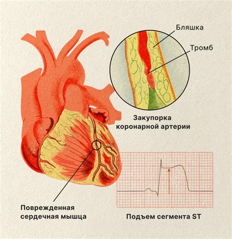 Тромболитическая терапия - препараты разрушают тромбы при инсульте